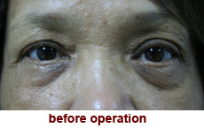 plastic-surgery-blepharoplasty